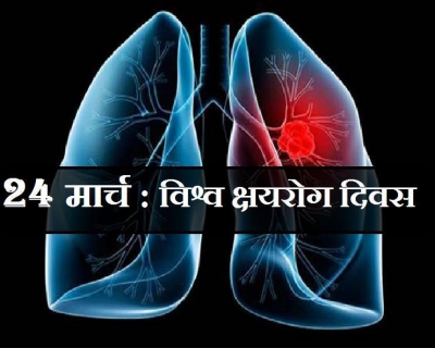 विश्व क्षयरोग दिवस, क्यों होती हैं यह बीमारी, जानिए लक्षण एवं उपाय