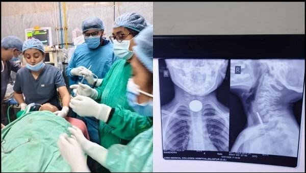 सिम्स बिलासपुर में डॉक्टरों का कमाल , 6 वर्षीय मासूम की आहार नली से सफलतापूर्वक निकाला गया सिक्का, बची जान
