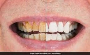 पीले दांतों को दूध सा चमका देंगी रसोई की ये 6 चीजें, जान लीजिए कमाल के नुस्खे यहां